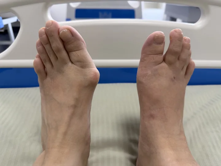 Сравнение стоп реального пациента после коррекции Hallux Valgus