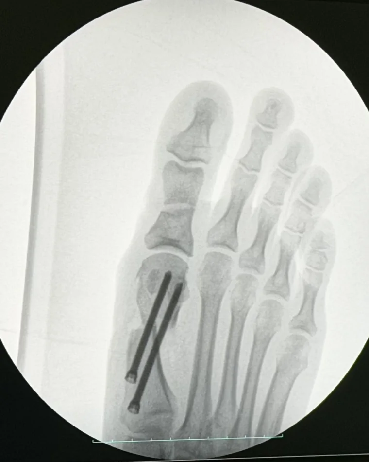 Контрольный рентген стопы после коррекции Hallux Valgus методом MICA: кость зафиксирована двумя винтами
