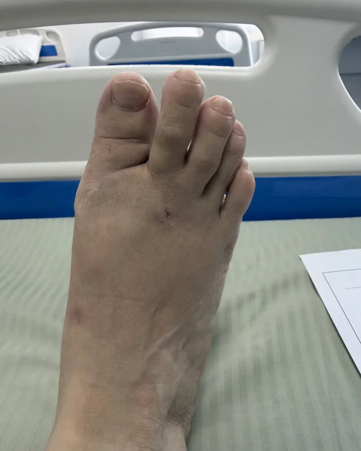 Заживший результат после коррекции Hallux Valgus — следы вмешательства почти незаметны