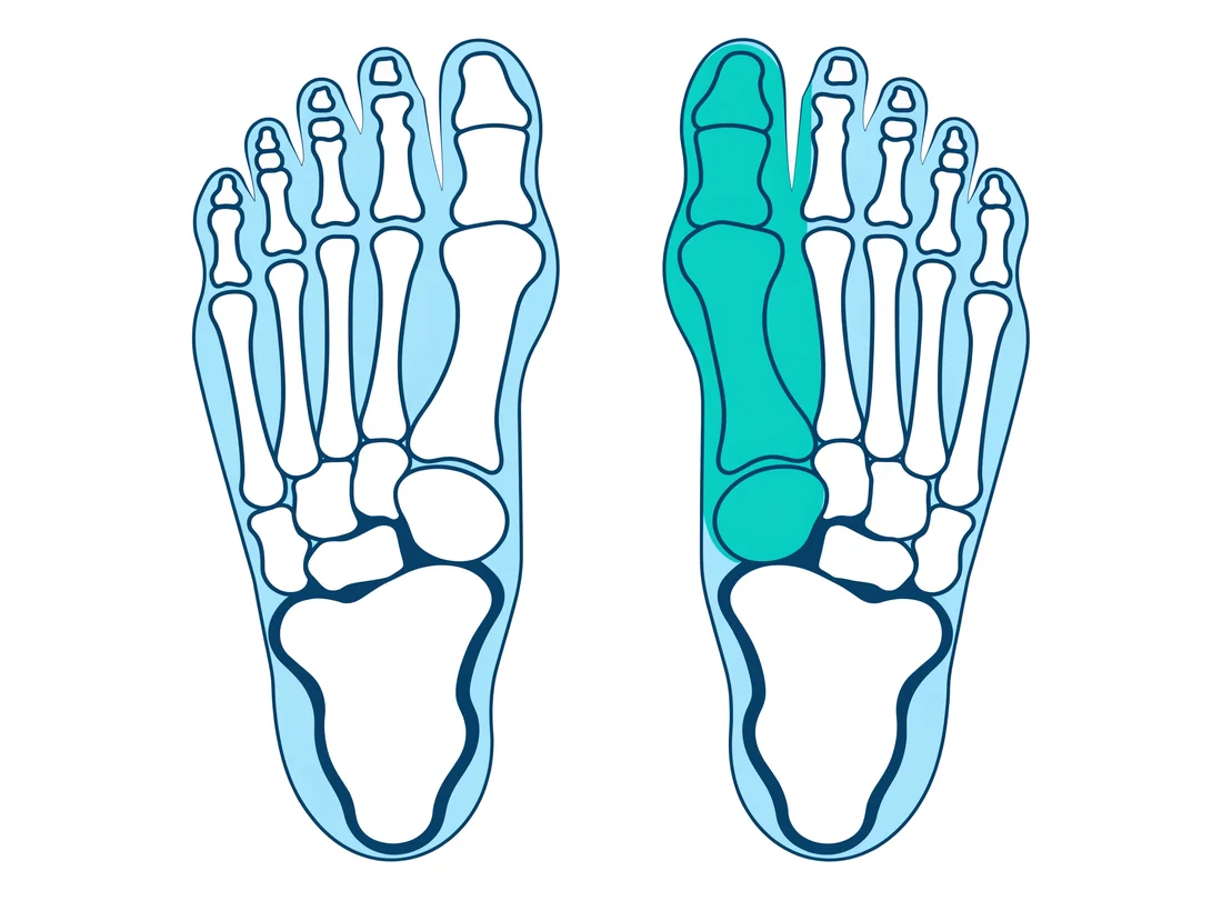 Схема: здоровая стопа и стопа с деформацией Hallux Valgus — большой палец отклонён, косточка выпирает